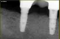 fianl x-ray, implant with crown